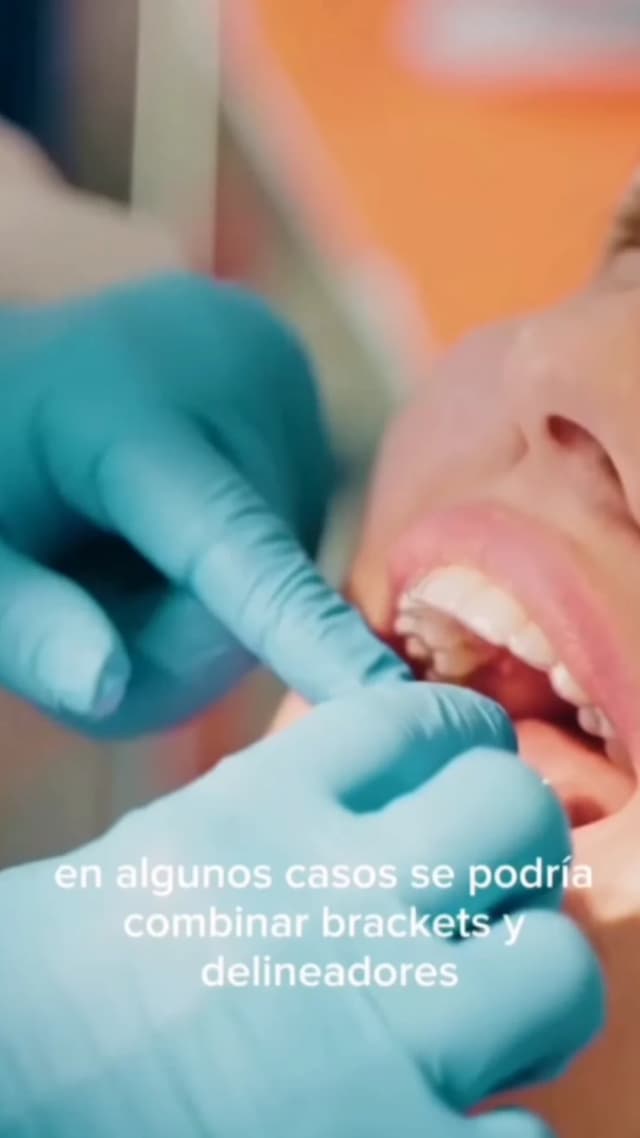 ¿Qué son los Alineadores?